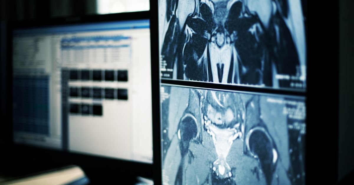 How Artificial Intelligence Impacts Cancer Screening and Surveillance: 3 Things to Know